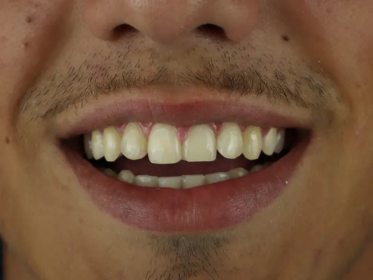 Sorriso do paciente antes do tratamento na Ferreira Lima Odontologia