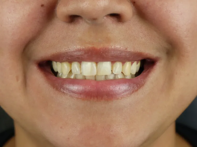 Sorriso do paciente antes do tratamento na Ferreira Lima Odontologia
