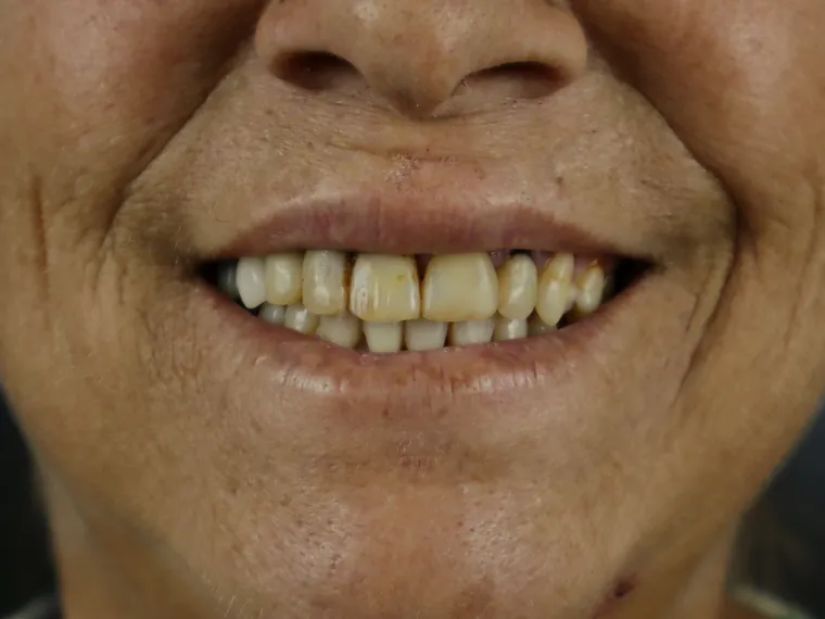 Sorriso do paciente antes do tratamento na Ferreira Lima Odontologia