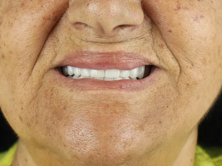 Sorriso do mesmo paciente depois do tratamento na Ferreira Lima Odontologia