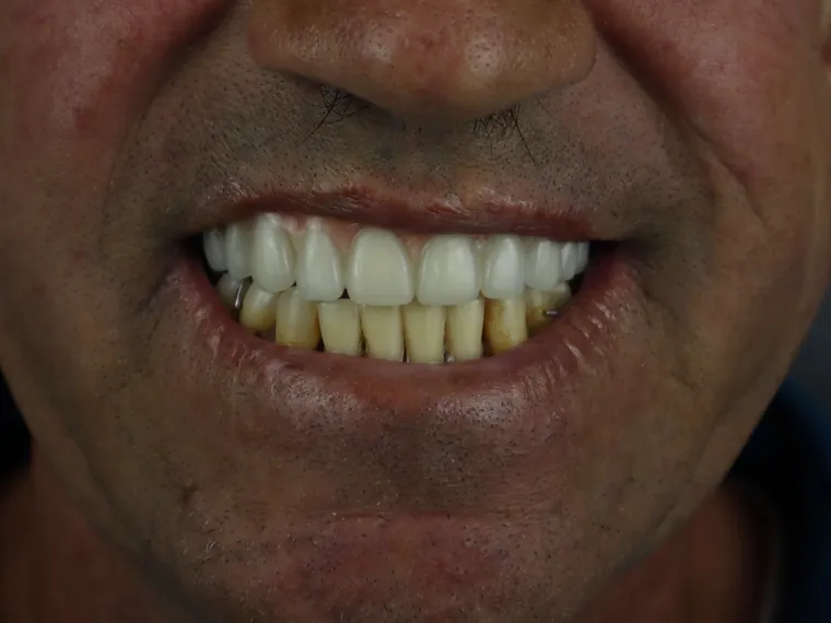 Sorriso do mesmo paciente depois do tratamento na Ferreira Lima Odontologia