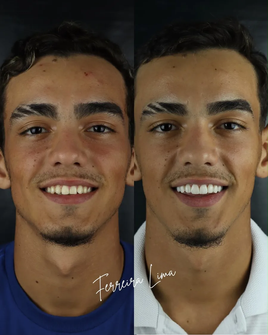 Facetas de resina: sorriso do paciente antes e depois do tratamento na Ferreira Lima Odontologia