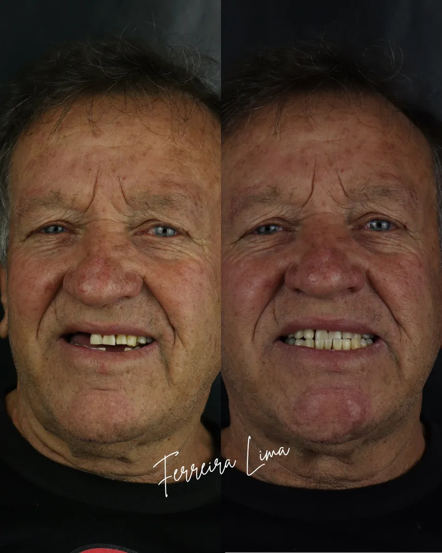 Prótese móvel flexível superior e inferior: sorriso do paciente antes e depois do tratamento na Ferreira Lima Odontologia