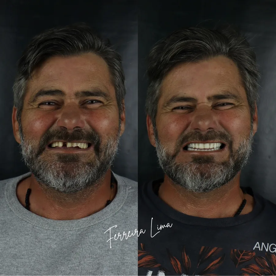 Troca de próteses móveis: sorriso do paciente antes e depois do tratamento na Ferreira Lima Odontologia